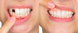 Happy Smile, funziona, come si usa, composizione, ingredienti