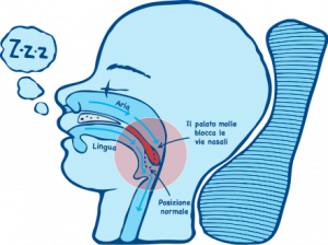 AirSnore, dove si compra, amazon, prezzo, farmacia