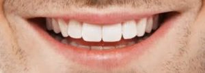 OralCare Pro, effetti collaterali