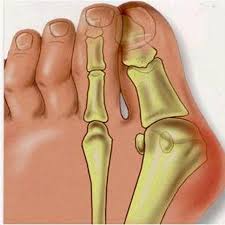 Footmate Valgus, funziona, come si usa