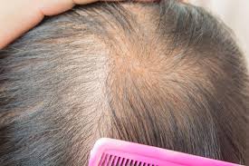 Hair Grow Max, dove si compra, amazon, prezzo, farmacia
