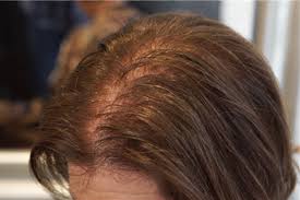 Hair Grow Max, Italia, originale, sito ufficiale