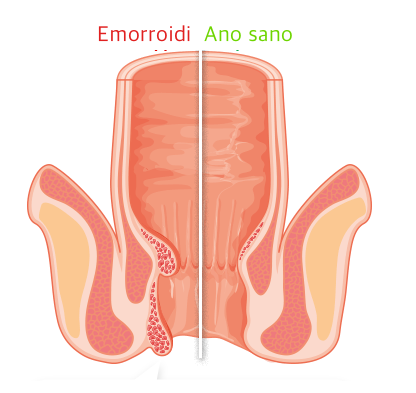 Hemoren Pro Comfort, prezzo, farmacia, amazon, dove si compra