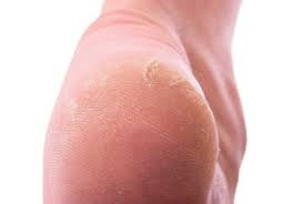 Callus Fresco Gel, originale, Italia, sito ufficiale