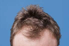 KeraHealth Hair Uomo, ingredienti, come si usa, funziona, composizione