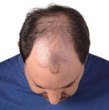KeraHealth Hair Uomo, amazon, prezzo, dove si compra, farmacia
