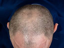 Hairstim, effetti collaterali, controindicazioni